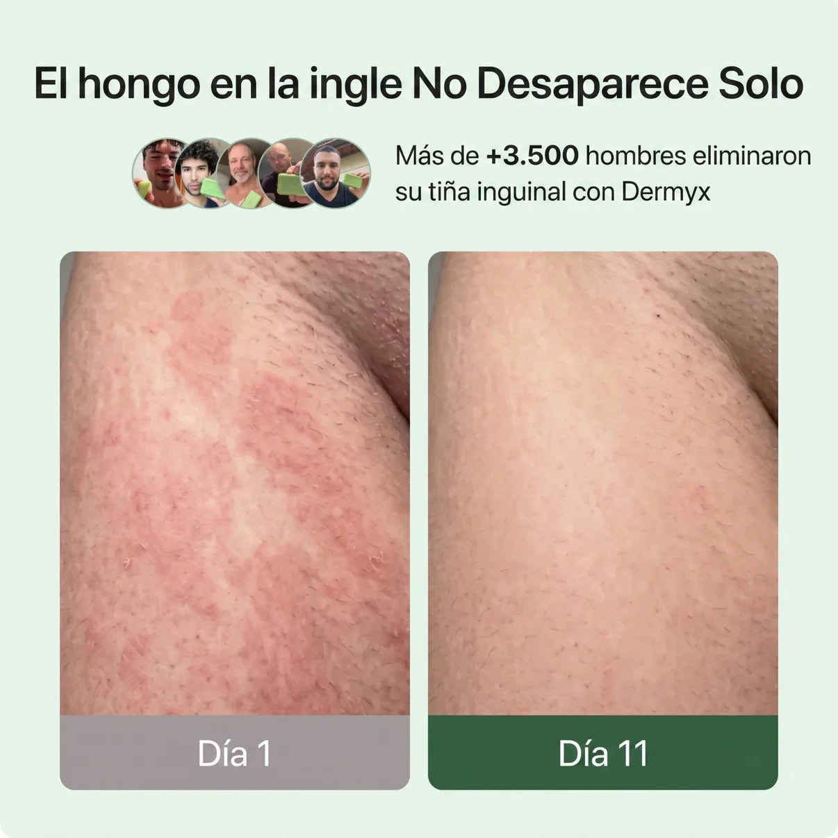 Dermyx® — Jabón Anti-hongos zona intima OFERTA X 3 Unidades